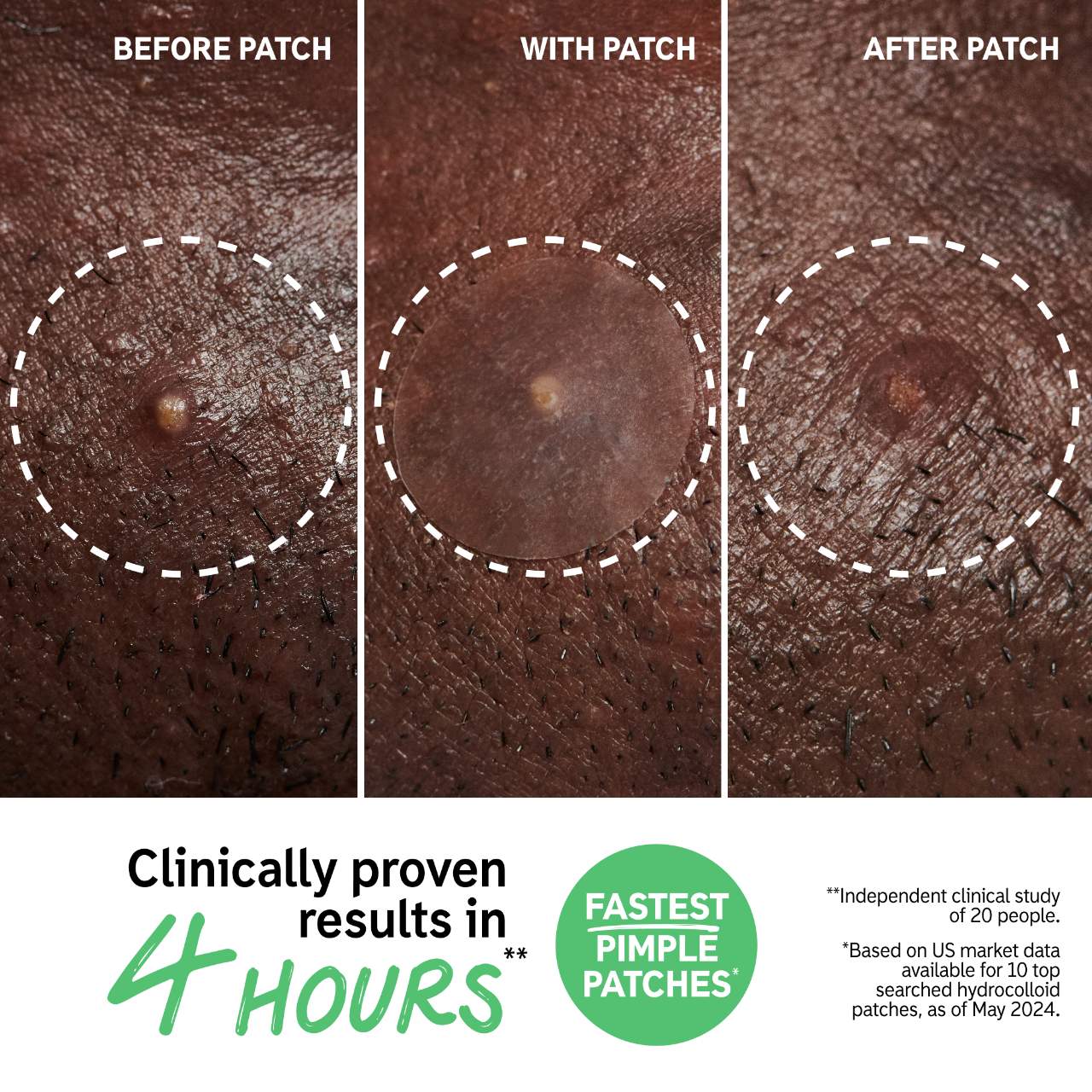 Hydrocolloid Invisible Pimple Patches + Salicylic Acid