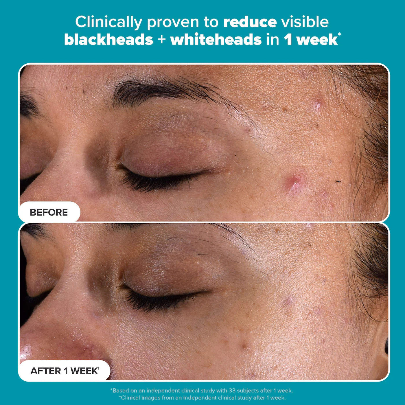 Skin Perfecting 2% BHA Exfoliating Toner Pads for Clear Skin
