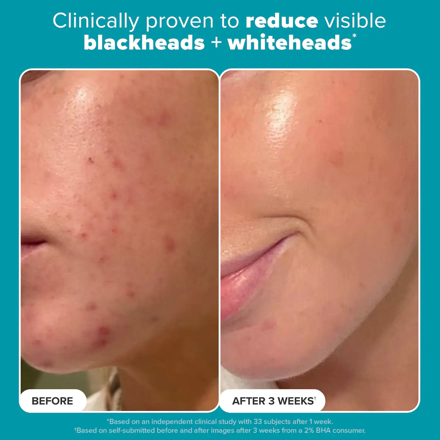 Skin Perfecting 2% BHA Exfoliating Toner Pads for Clear Skin