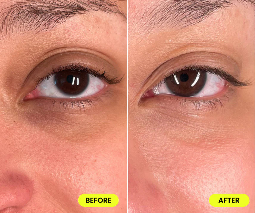Dark Circle Vitaleyez Treatment
