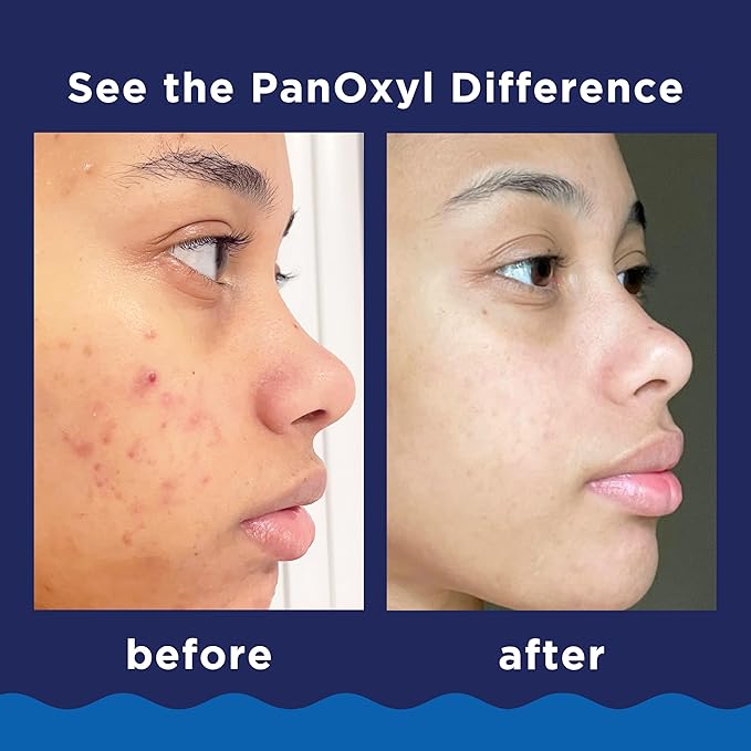 PanOxyl 10% Benzoyl Peroxide Acne Foaming Wash, Maximum Strength, Daily Acne-Fighting Face and Body Cleanser