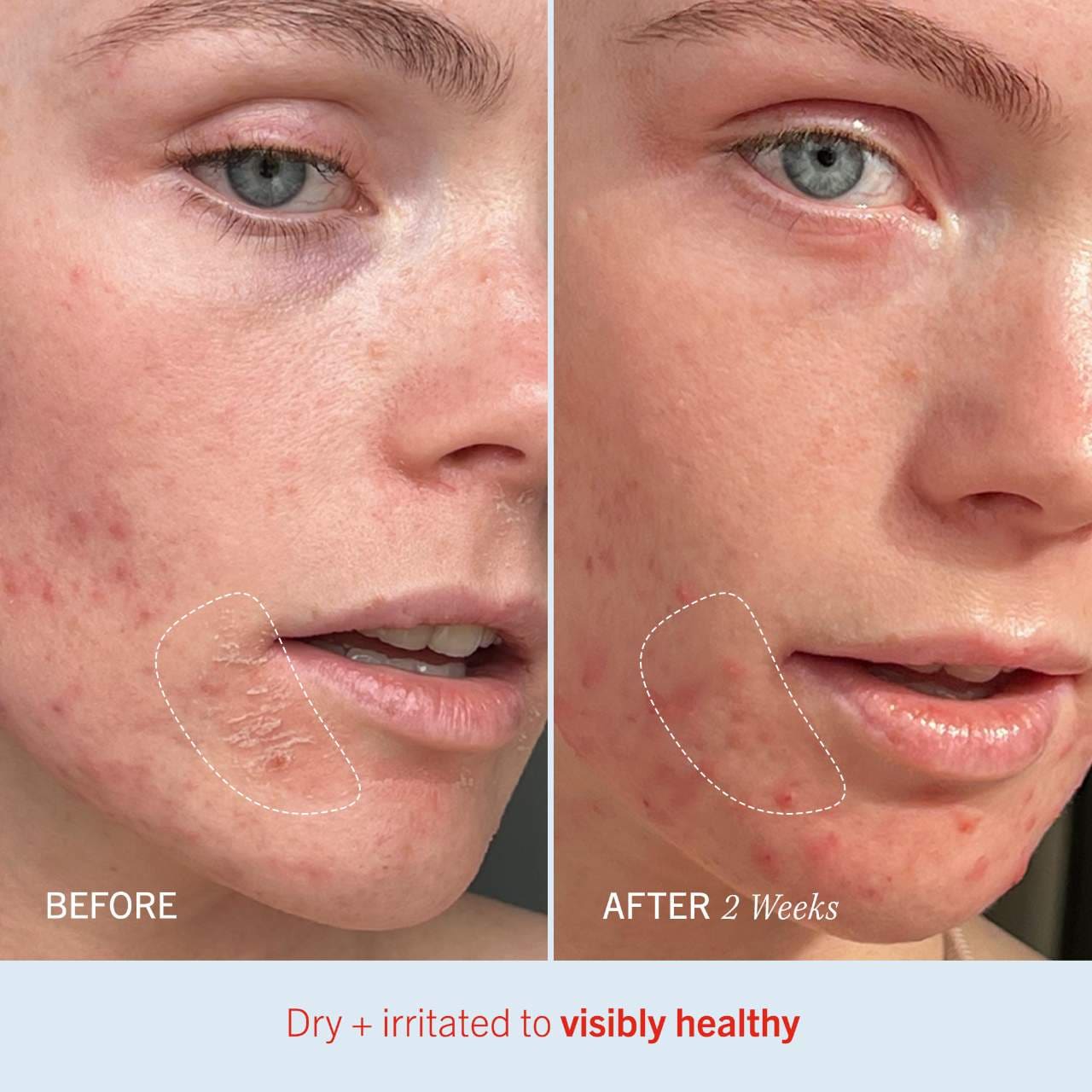 Ultra Repair® Cream Intense Hydration – Face and Body Moisturizer for Skin Repair