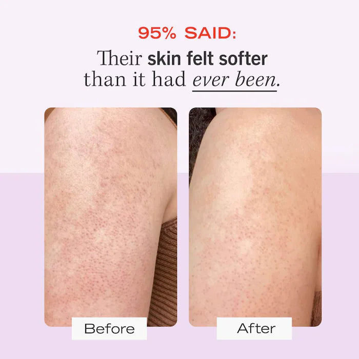 KP Bump Eraser Body Scrub with 10% AHA – Body Exfoliant for Keratosis Pilaris