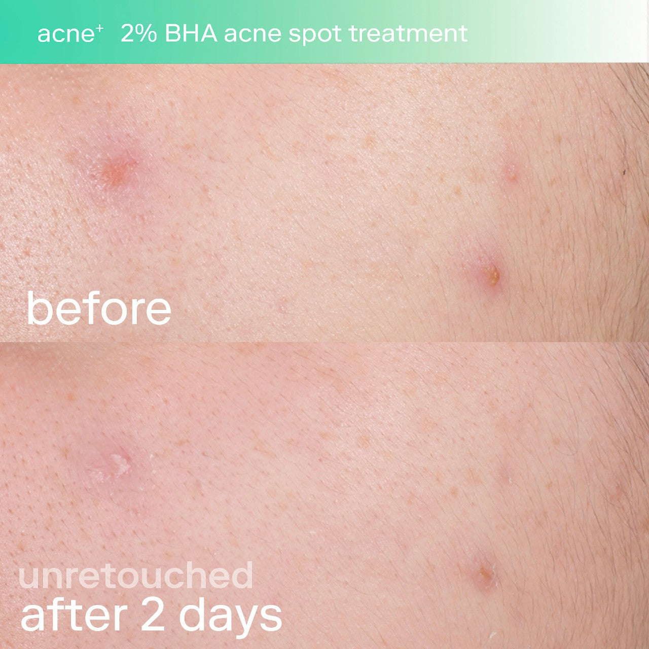 Acne+ 2% BHA and Azelaic Acid Acne Spot Treatment