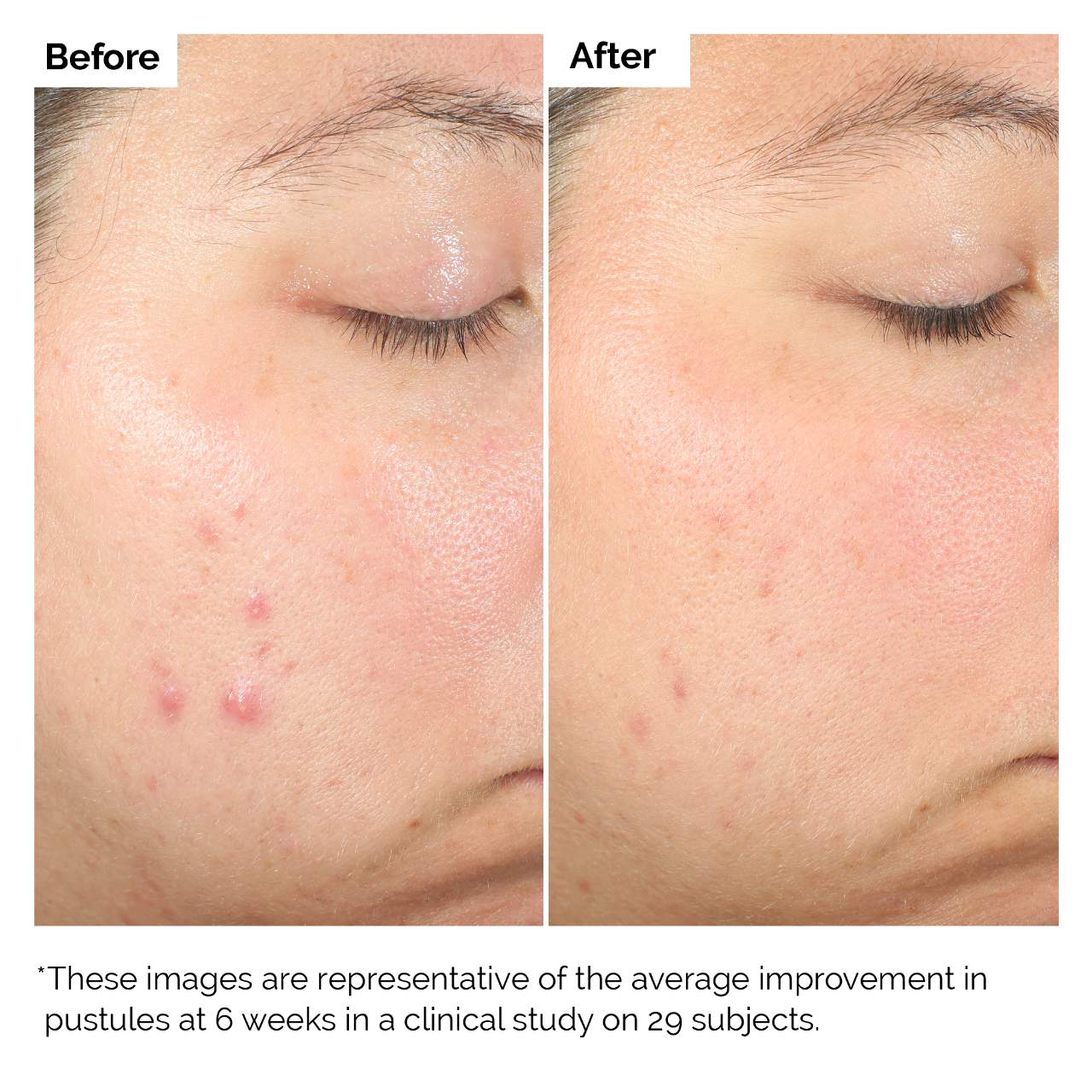 Salicylic Acid 2% Solution, Exfoliating Serum for Acne