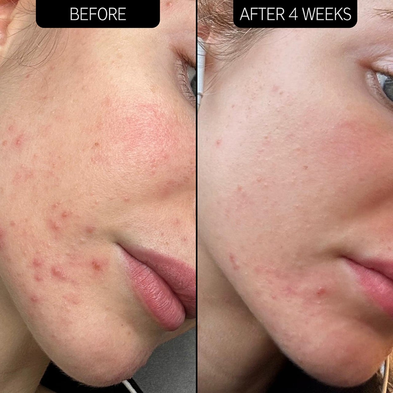 SuperSolutions Acne Clearing Moisturizer 2% NOVORETINᵀᴹ
