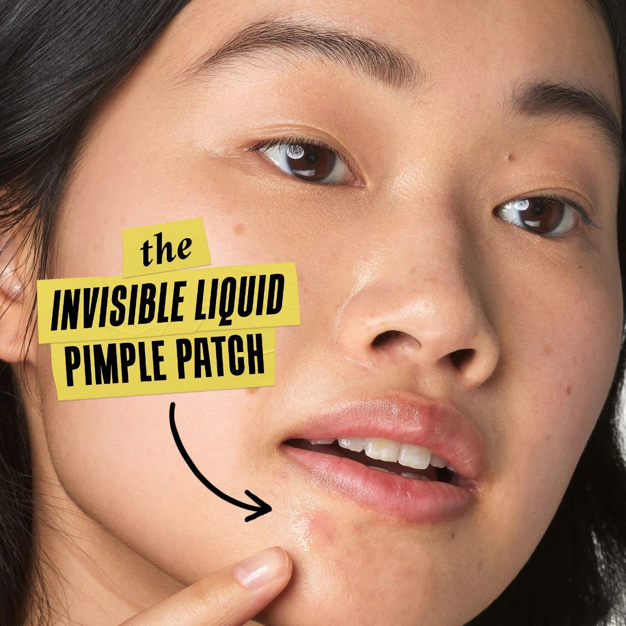 Truly Targeted Acne-Clearing Salicylic Acid Pimple Patch