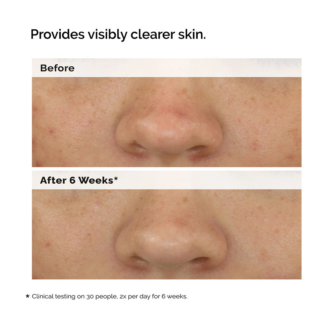Balancing & Clarifying Serum for Oily Skin and Pore Refinement