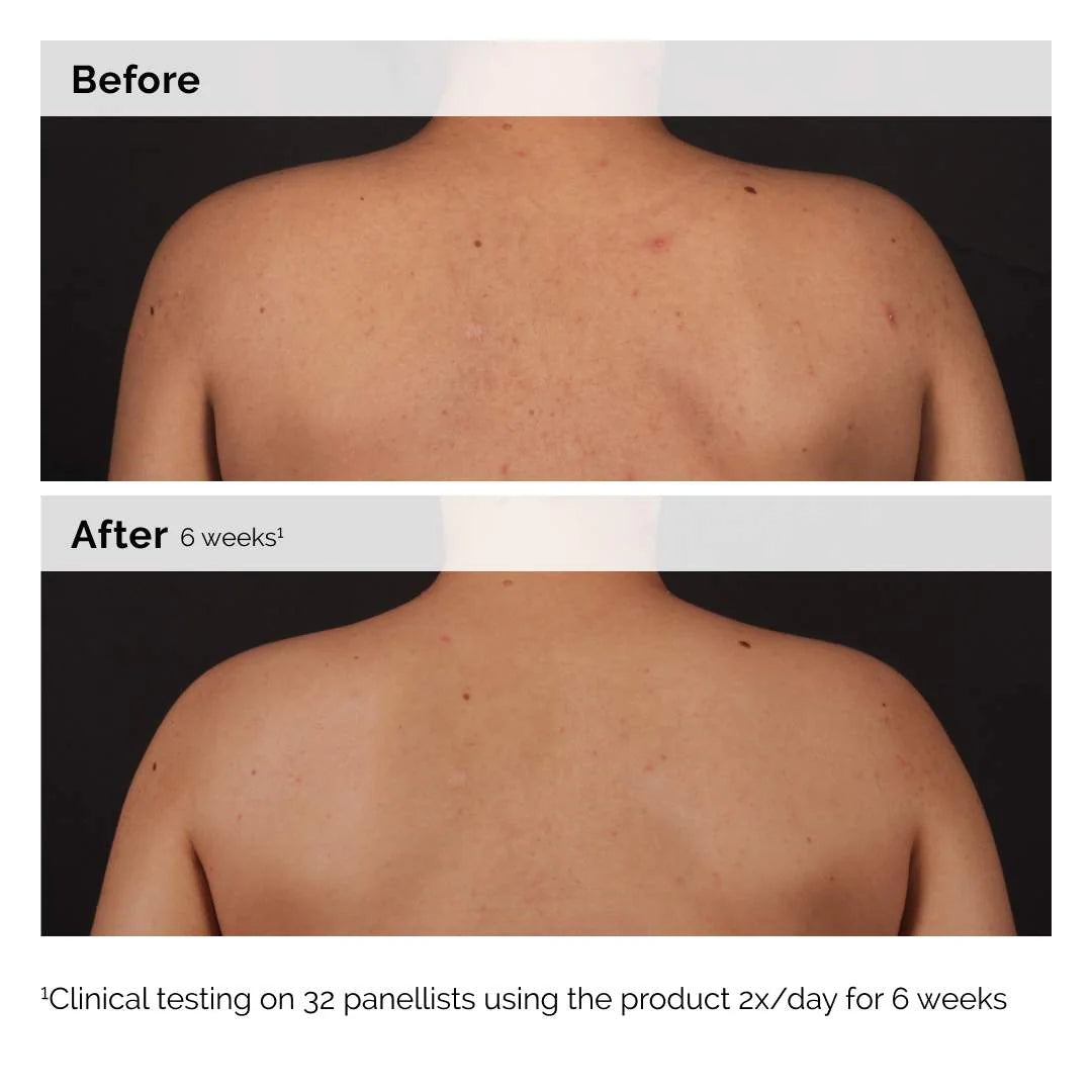 Salicylic Acid 0.5% Body Serum Exfoliating Treatment for Acne