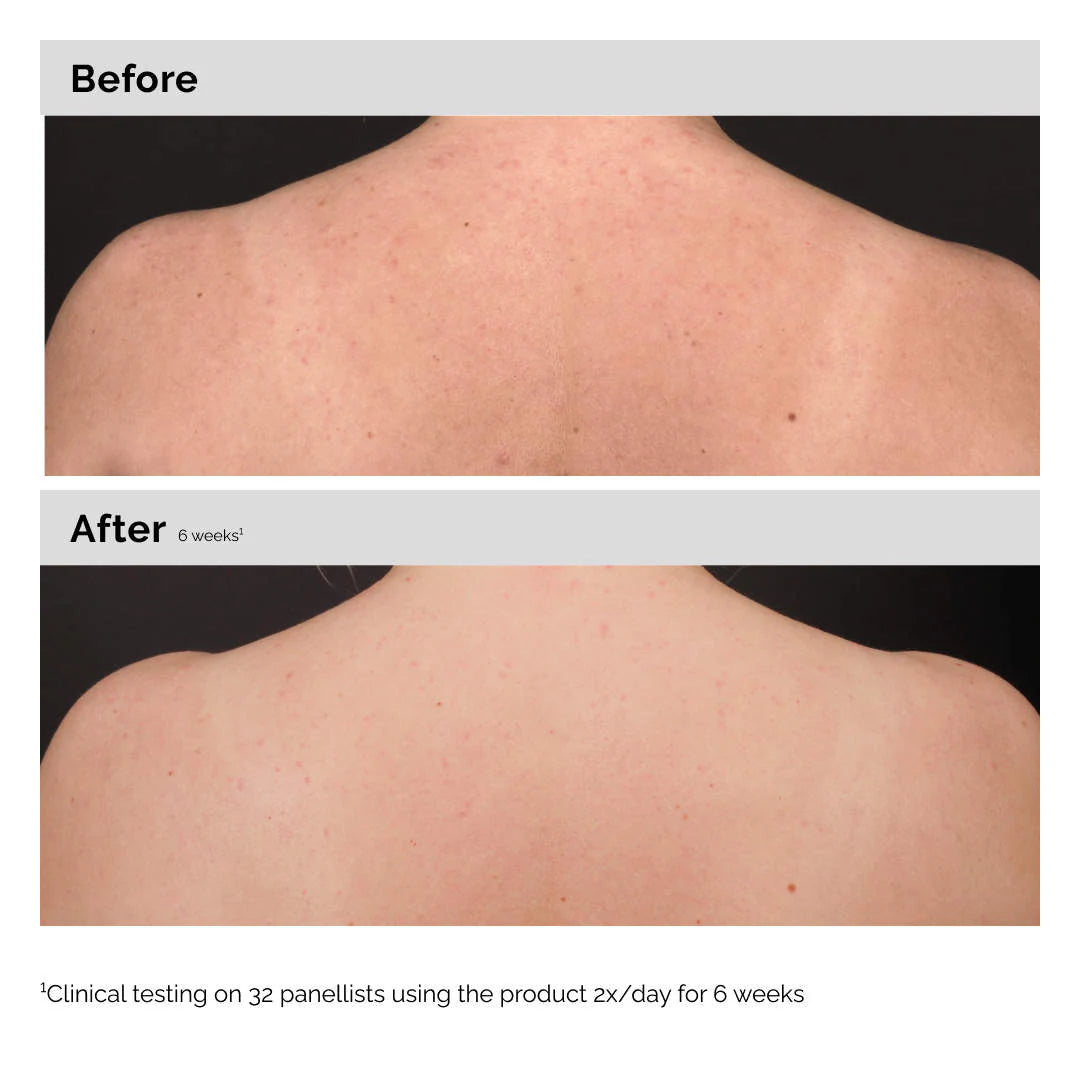 Salicylic Acid 0.5% Body Serum Exfoliating Treatment for Acne