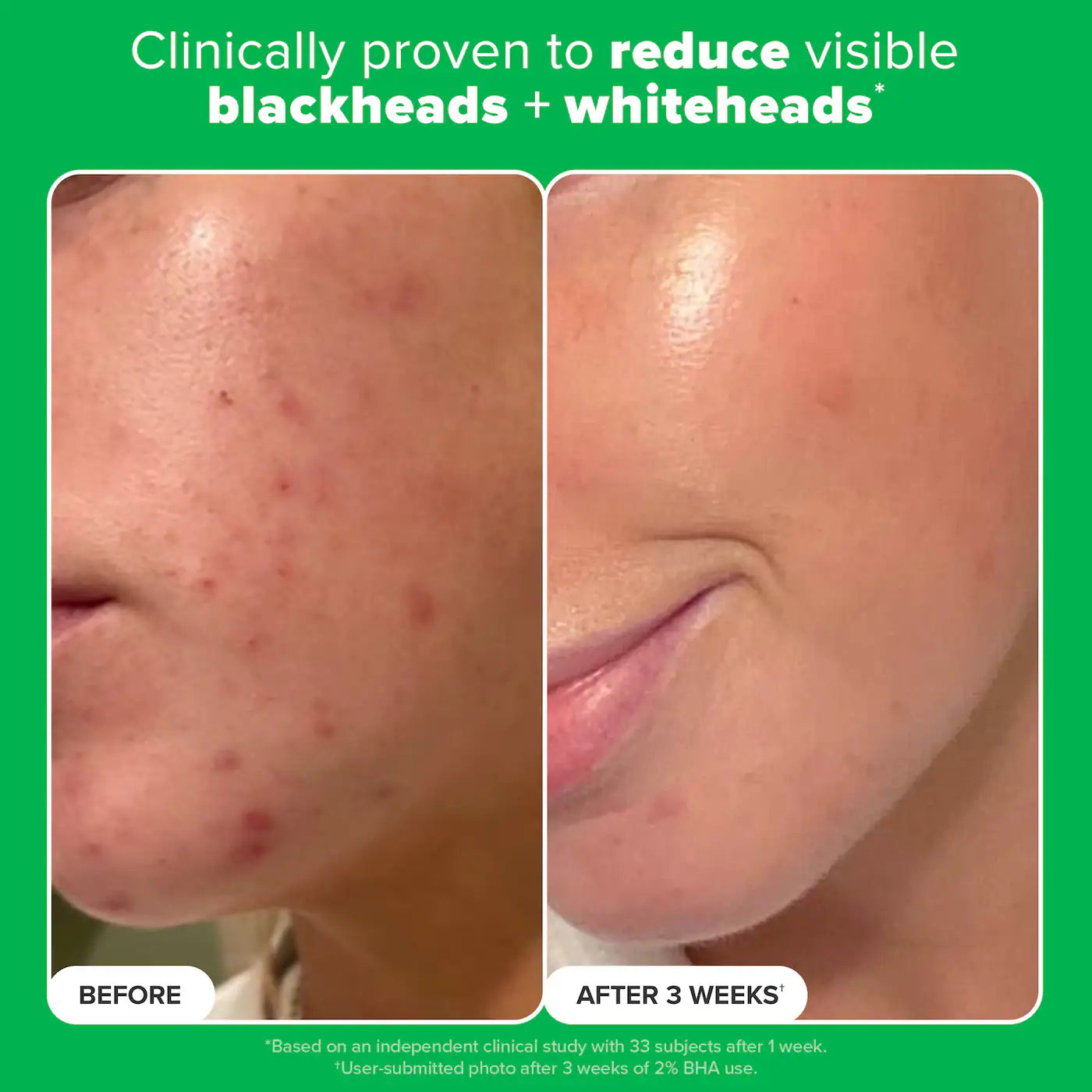 Complexion Clarity Duo with Salicylic Acid & Azelaic Acid