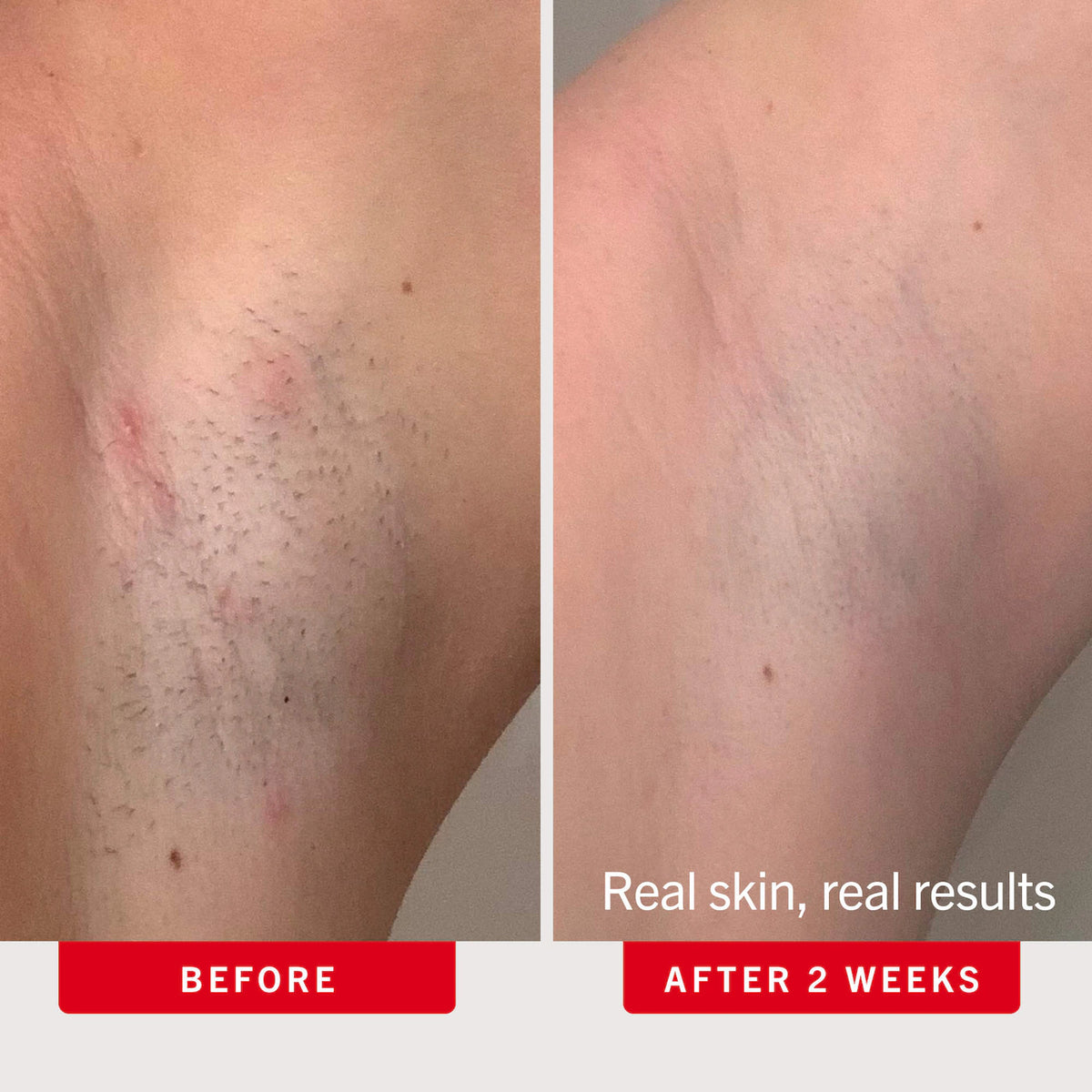 Ingrown Hair Pads with BHA & AHA