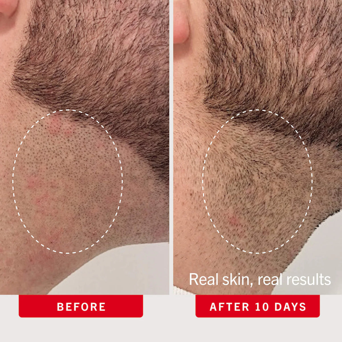 Ingrown Hair Pads with BHA & AHA