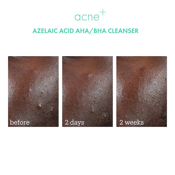 Acne+ 2% BHA + Azelaic Acid + Niacinamide + AHA Cleanser